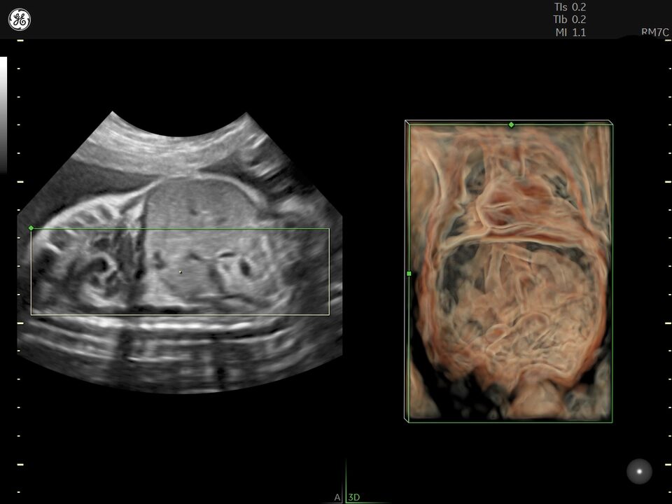 Ecografie de morfologie fetala: când trebuie făcută și ce rol are? 1 Voluson E22 - Ecografie Morfofetala